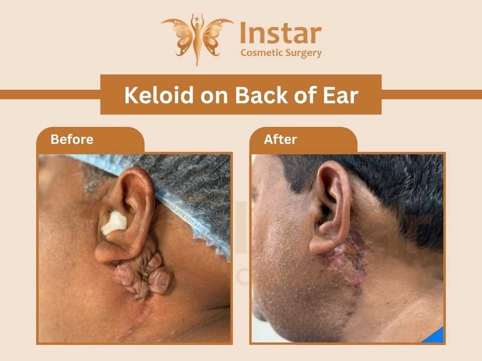 Keloid on Back of Ear